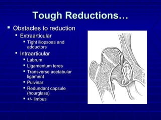Tough Reductions…Tough Reductions…
 Obstacles to reductionObstacles to reduction
 ExtraarticularExtraarticular
 Tight iliopsoas andTight iliopsoas and
adductorsadductors
 IntraarticularIntraarticular
 LabrumLabrum
 Ligamentum teresLigamentum teres
 Transverse acetabularTransverse acetabular
ligamentligament
 PulvinarPulvinar
 Redundant capsuleRedundant capsule
(hourglass)(hourglass)
 +/- limbus+/- limbus
 