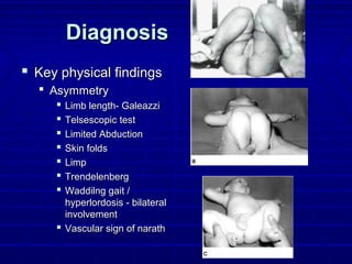 DiagnosisDiagnosis
 Key physical findingsKey physical findings
 AsymmetryAsymmetry
 Limb length- GaleazziLimb length- Galeazzi
 Telsescopic testTelsescopic test
 Limited AbductionLimited Abduction
 Skin foldsSkin folds
 LimpLimp
 TrendelenbergTrendelenberg
 Waddilng gait /Waddilng gait /
hyperlordosis - bilateralhyperlordosis - bilateral
involvementinvolvement
 Vascular sign of narathVascular sign of narath
 