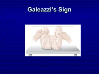 Galeazzi’s SignGaleazzi’s Sign
 