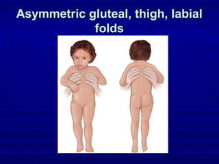 Asymmetric gluteal, thigh, labialAsymmetric gluteal, thigh, labial
foldsfolds
 