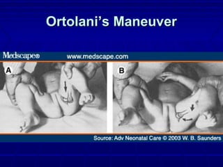 Ortolani’s ManeuverOrtolani’s Maneuver
 