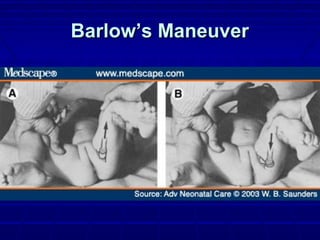 Barlow’s ManeuverBarlow’s Maneuver
 