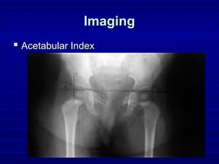 ImagingImaging
 Acetabular IndexAcetabular Index
 