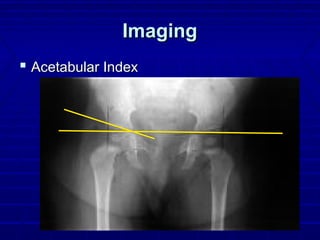 ImagingImaging
 Acetabular IndexAcetabular Index
 