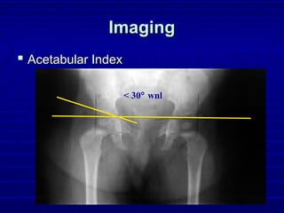 ImagingImaging
 Acetabular IndexAcetabular Index
< 30° wnl
 