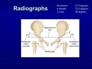 RadiographsRadiographs
Newborns 27.5 degrees
6 months 23.5 degrees
2 years 20 degrees
 