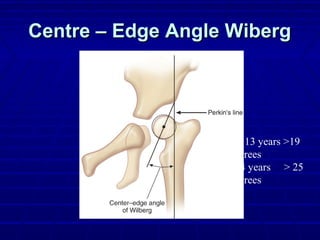 Centre – Edge Angle WibergCentre – Edge Angle Wiberg
6 – 13 years >19
degrees
>14 years > 25
degrees
 