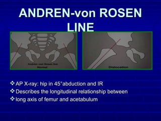 ANDREN-von ROSENANDREN-von ROSEN
LINELINE
AP X-ray: hip in 45AP X-ray: hip in 45°abduction and IR°abduction and IR
Describes the longitudinal relationship betweenDescribes the longitudinal relationship between
long axis of femur and acetabulumlong axis of femur and acetabulum
 