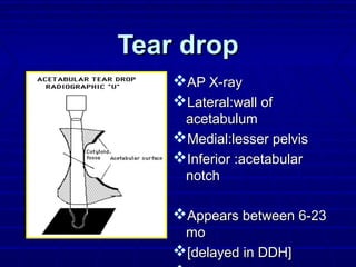 Tear dropTear drop
AP X-rayAP X-ray
Lateral:wall ofLateral:wall of
acetabulumacetabulum
Medial:lesser pelvisMedial:lesser pelvis
Inferior :acetabularInferior :acetabular
notchnotch
Appears between 6-23Appears between 6-23
momo
[delayed in DDH][delayed in DDH]
 