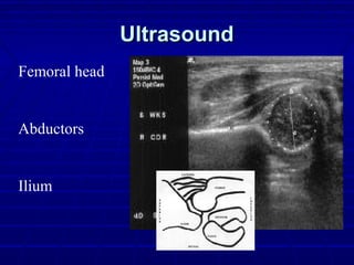 UltrasoundUltrasound
Femoral head
Abductors
Ilium
 