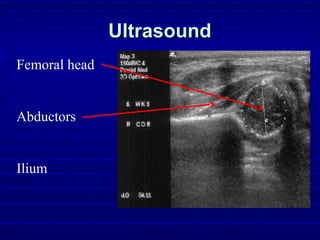 UltrasoundUltrasound
Femoral head
Abductors
Ilium
 