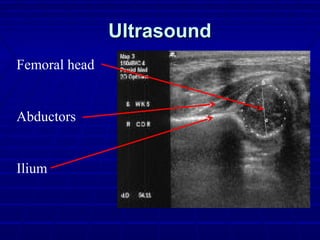 UltrasoundUltrasound
Femoral head
Abductors
Ilium
 