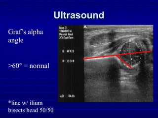UltrasoundUltrasound
Graf’s alpha
angle
>60° = normal
*line w/ ilium
bisects head 50/50
 