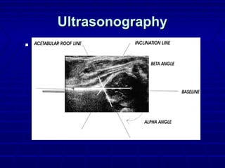 UltrasonographyUltrasonography
 lpha angle measures bony acetabuluBetalpha angle measures bony acetabuluBeta
angle measures cartilagenous acetabulumangle measures cartilagenous acetabulum
 