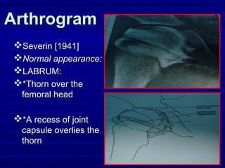ArthrogramArthrogram
Severin [1941]Severin [1941]
Normal appearance:Normal appearance:
LABRUM:LABRUM:
*Thorn over the*Thorn over the
femoral headfemoral head
*A recess of joint*A recess of joint
capsule overlies thecapsule overlies the
thornthorn
 