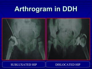 Arthrogram in DDHArthrogram in DDH
SUBLUXATED HIP DISLOCATED HIP
 