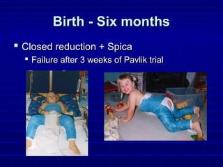 Birth - Six monthsBirth - Six months
 Closed reduction + SpicaClosed reduction + Spica
 Failure after 3 weeks of Pavlik trialFailure after 3 weeks of Pavlik trial
 
