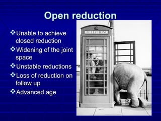 Open reductionOpen reduction
Unable to achieveUnable to achieve
closed reductionclosed reduction
Widening of the jointWidening of the joint
spacespace
Unstable reductionsUnstable reductions
Loss of reduction onLoss of reduction on
follow upfollow up
Advanced ageAdvanced age
 