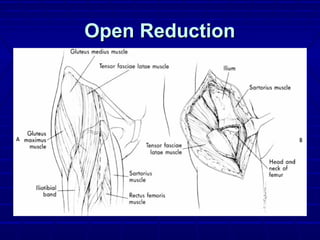 Open ReductionOpen Reduction
 