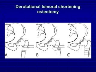 Derotational femoral shorteningDerotational femoral shortening
osteotomyosteotomy
 