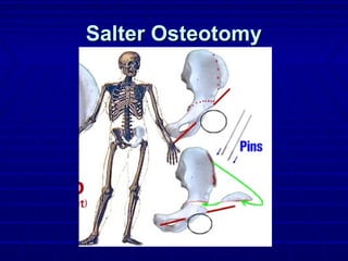 Salter OsteotomySalter Osteotomy
 