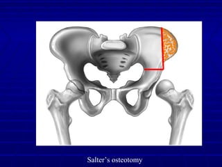 Salter’s osteotomy
 