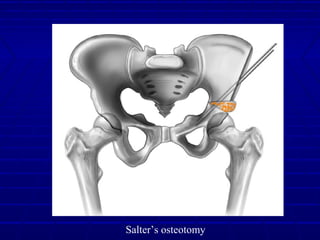 Salter’s osteotomy
 