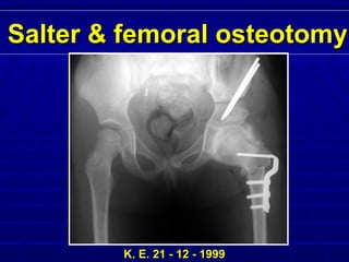 K. E. 21 - 12 - 1999
Salter & femoral osteotomySalter & femoral osteotomy
 