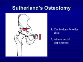 Sutherland’s OsteotomySutherland’s Osteotomy
1. Can be done for older
child
2. Allows medial
displacement
 