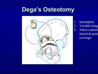 Dega’s OsteotomyDega’s Osteotomy
1. Incomplete
2. Variable hinge
3. Allows anterio
lateral & poste
coverage
 