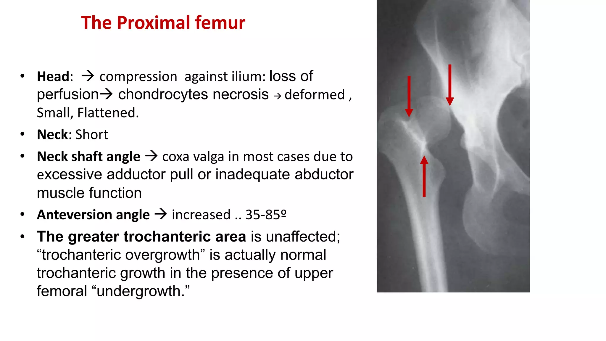 • Head:  compression against ilium: loss of
perfusion chondrocytes necrosis  deformed ,
Small, Flattened.
• Neck: Short
• Neck shaft angle  coxa valga in most cases due to
excessive adductor pull or inadequate abductor
muscle function
• Anteversion angle  increased .. 35-85º
• The greater trochanteric area is unaffected;
“trochanteric overgrowth” is actually normal
trochanteric growth in the presence of upper
femoral “undergrowth.”
The Proximal femur
 