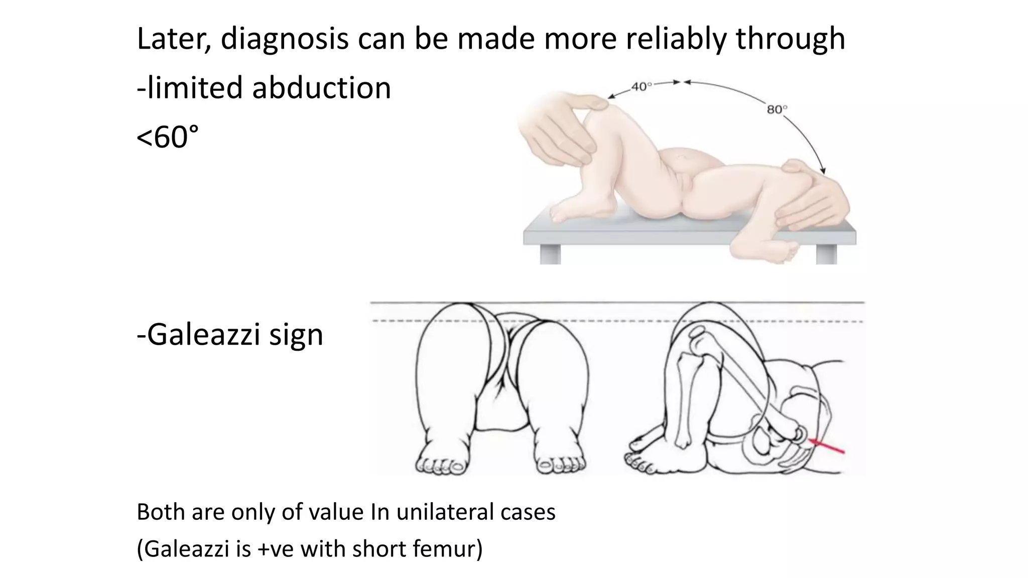 Later, diagnosis can be made more reliably through
-limited abduction
<60°
-Galeazzi sign
Both are only of value In unilateral cases
(Galeazzi is +ve with short femur)
 