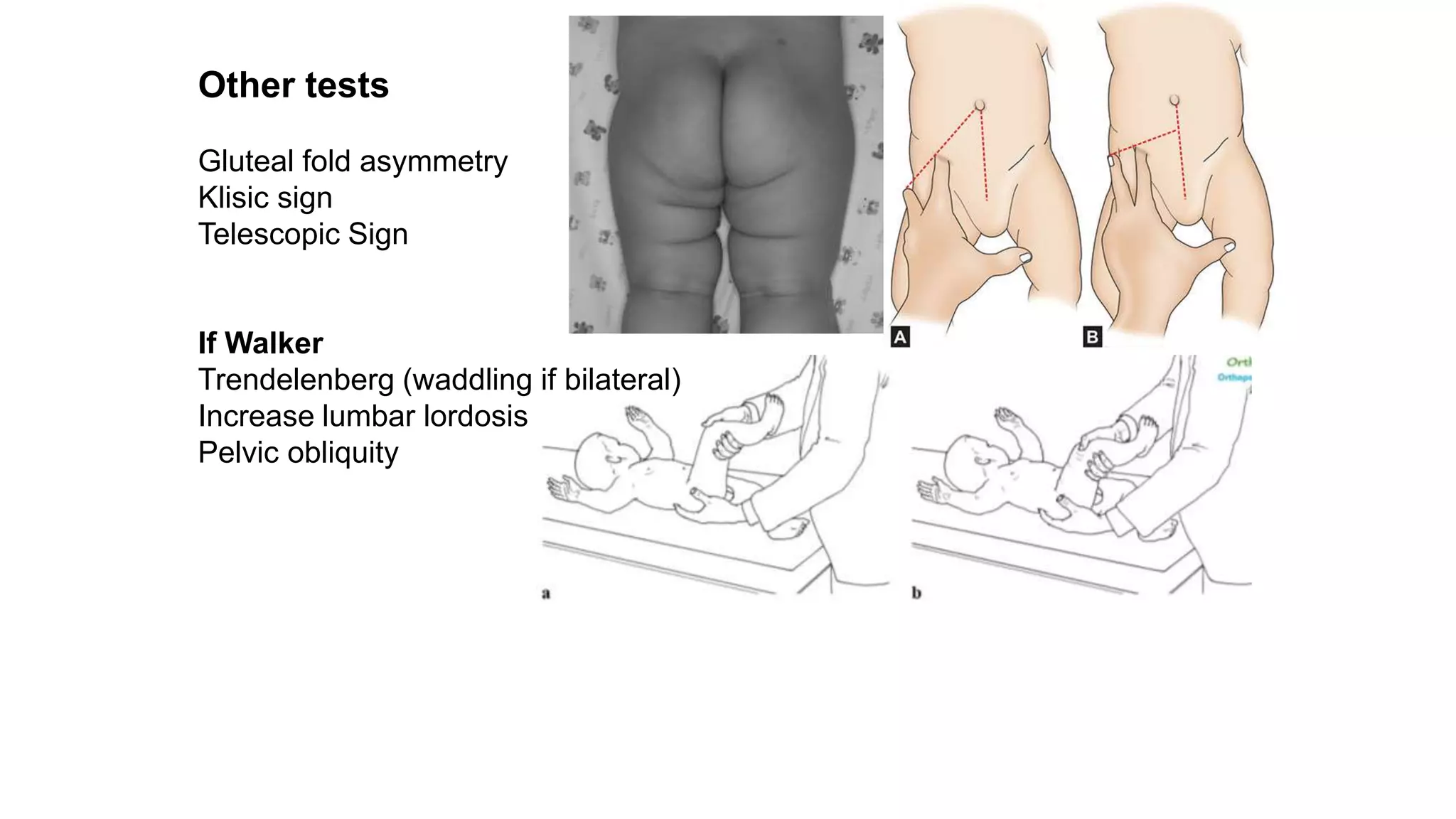 Other tests
Gluteal fold asymmetry
Klisic sign
Telescopic Sign
If Walker
Trendelenberg (waddling if bilateral)
Increase lumbar lordosis
Pelvic obliquity
 