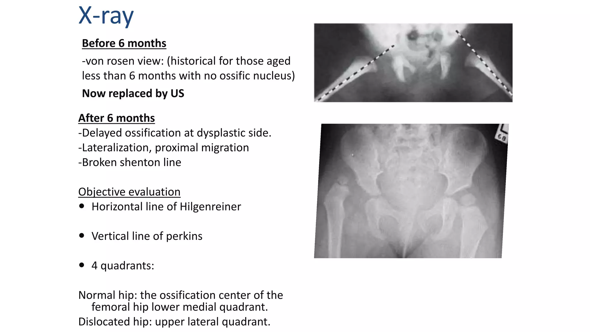 X-ray
After 6 months
-Delayed ossification at dysplastic side.
-Lateralization, proximal migration
-Broken shenton line
Objective evaluation
 Horizontal line of Hilgenreiner
 Vertical line of perkins
 4 quadrants:
Normal hip: the ossification center of the
femoral hip lower medial quadrant.
Dislocated hip: upper lateral quadrant.
Before 6 months
-von rosen view: (historical for those aged
less than 6 months with no ossific nucleus)
Now replaced by US
 
