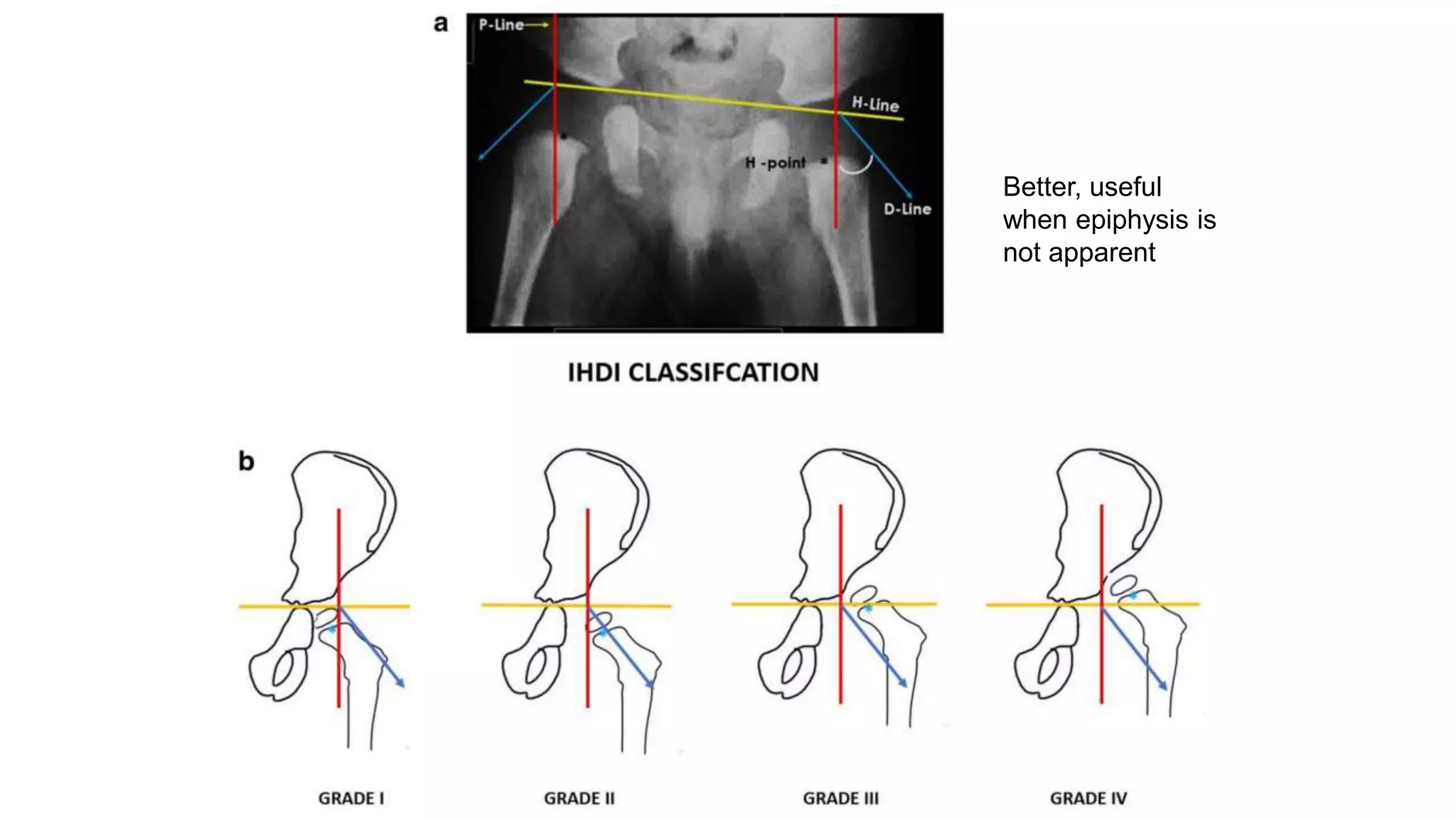 Better, useful
when epiphysis is
not apparent
 