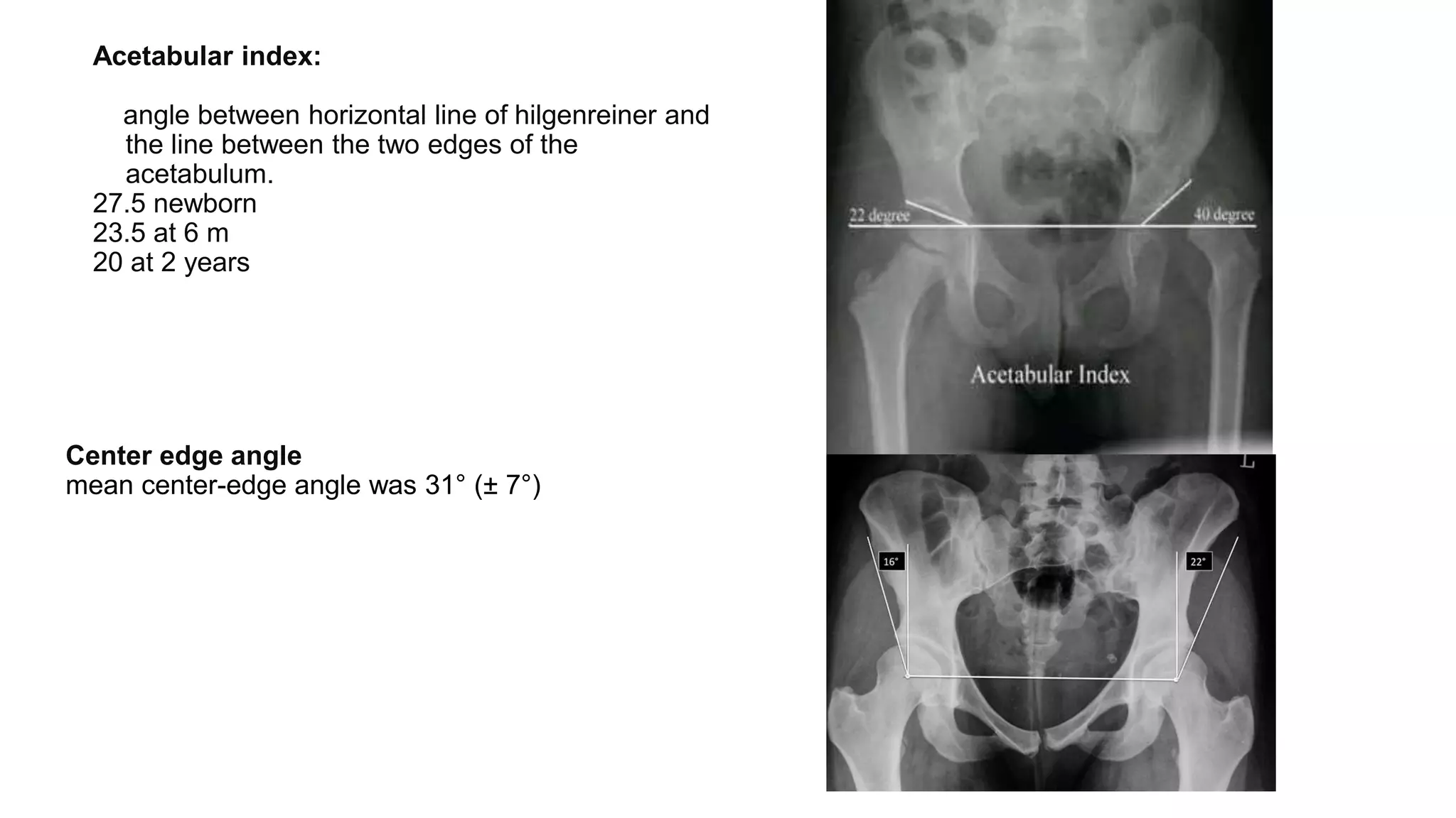 Acetabular index:
angle between horizontal line of hilgenreiner and
the line between the two edges of the
acetabulum.
27.5 newborn
23.5 at 6 m
20 at 2 years
Center edge angle
mean center-edge angle was 31° (± 7°)
 