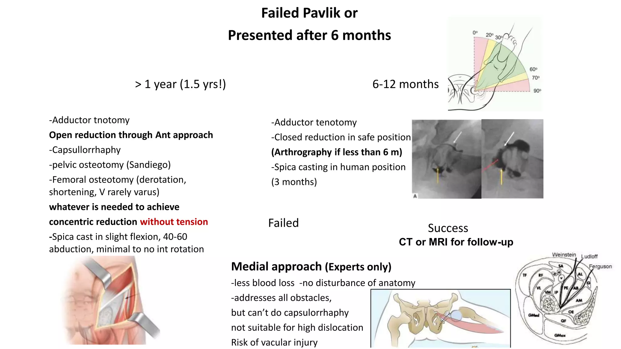 Failed Pavlik or
Presented after 6 months
6-12 months
-Adductor tenotomy
-Closed reduction in safe position
(Arthrography if less than 6 m)
-Spica casting in human position
(3 months)
> 1 year (1.5 yrs!)
Success
CT or MRI for follow-up
Failed
Medial approach (Experts only)
-less blood loss -no disturbance of anatomy
-addresses all obstacles,
but can’t do capsulorrhaphy
not suitable for high dislocation
Risk of vacular injury
-Adductor tnotomy
Open reduction through Ant approach
-Capsullorrhaphy
-pelvic osteotomy (Sandiego)
-Femoral osteotomy (derotation,
shortening, V rarely varus)
whatever is needed to achieve
concentric reduction without tension
-Spica cast in slight flexion, 40-60
abduction, minimal to no int rotation
 