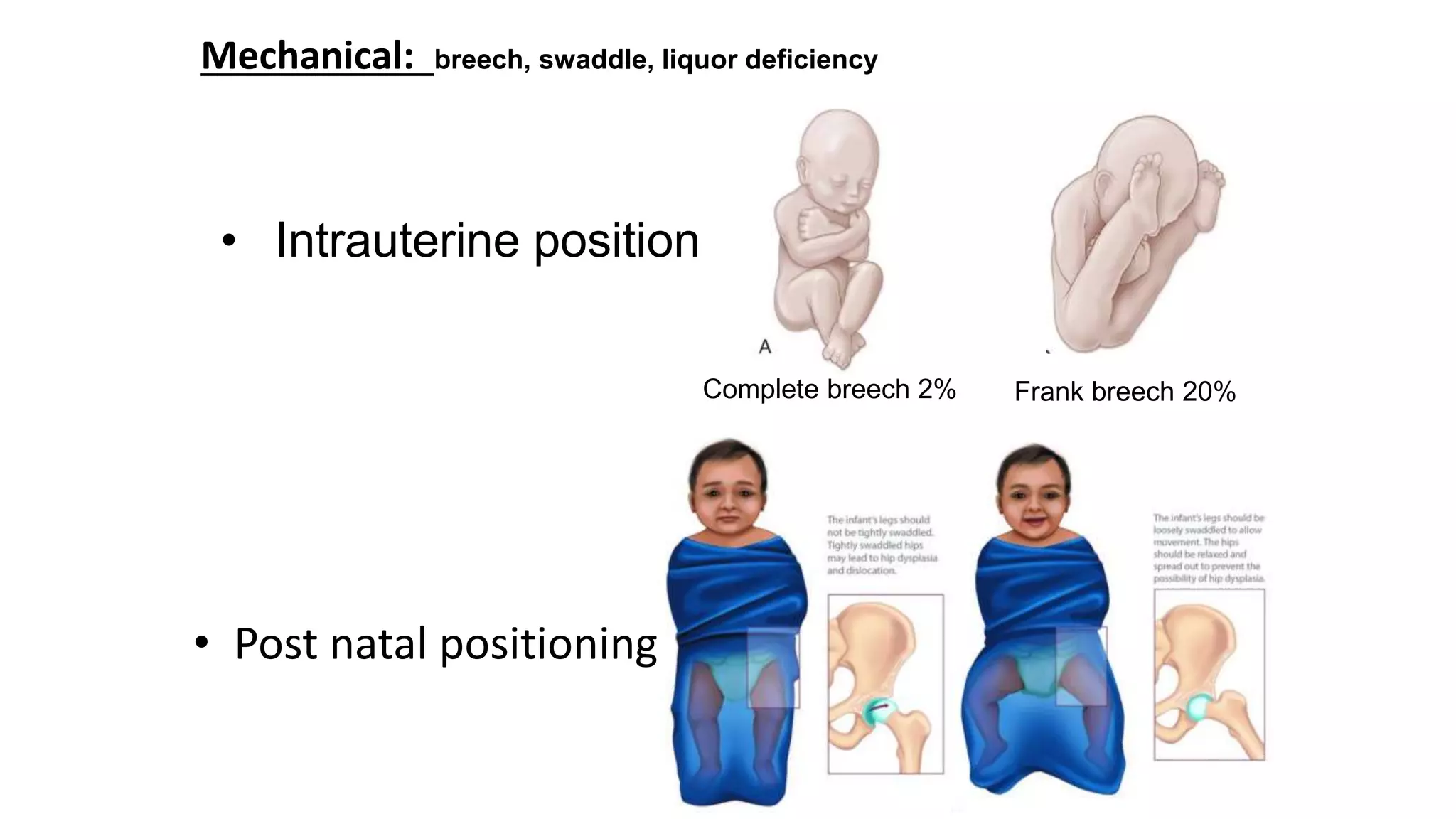 • Post natal positioning
Complete breech 2% Frank breech 20%
Mechanical: breech, swaddle, liquor deficiency
• Intrauterine position
 
