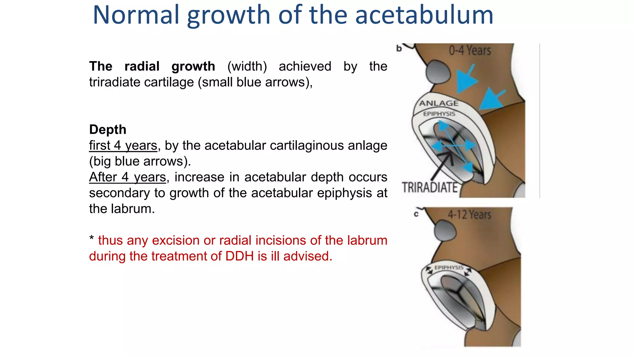 The radial growth (width) achieved by the
triradiate cartilage (small blue arrows),
Depth
first 4 years, by the acetabular cartilaginous anlage
(big blue arrows).
After 4 years, increase in acetabular depth occurs
secondary to growth of the acetabular epiphysis at
the labrum.
* thus any excision or radial incisions of the labrum
during the treatment of DDH is ill advised.
Normal growth of the acetabulum
 