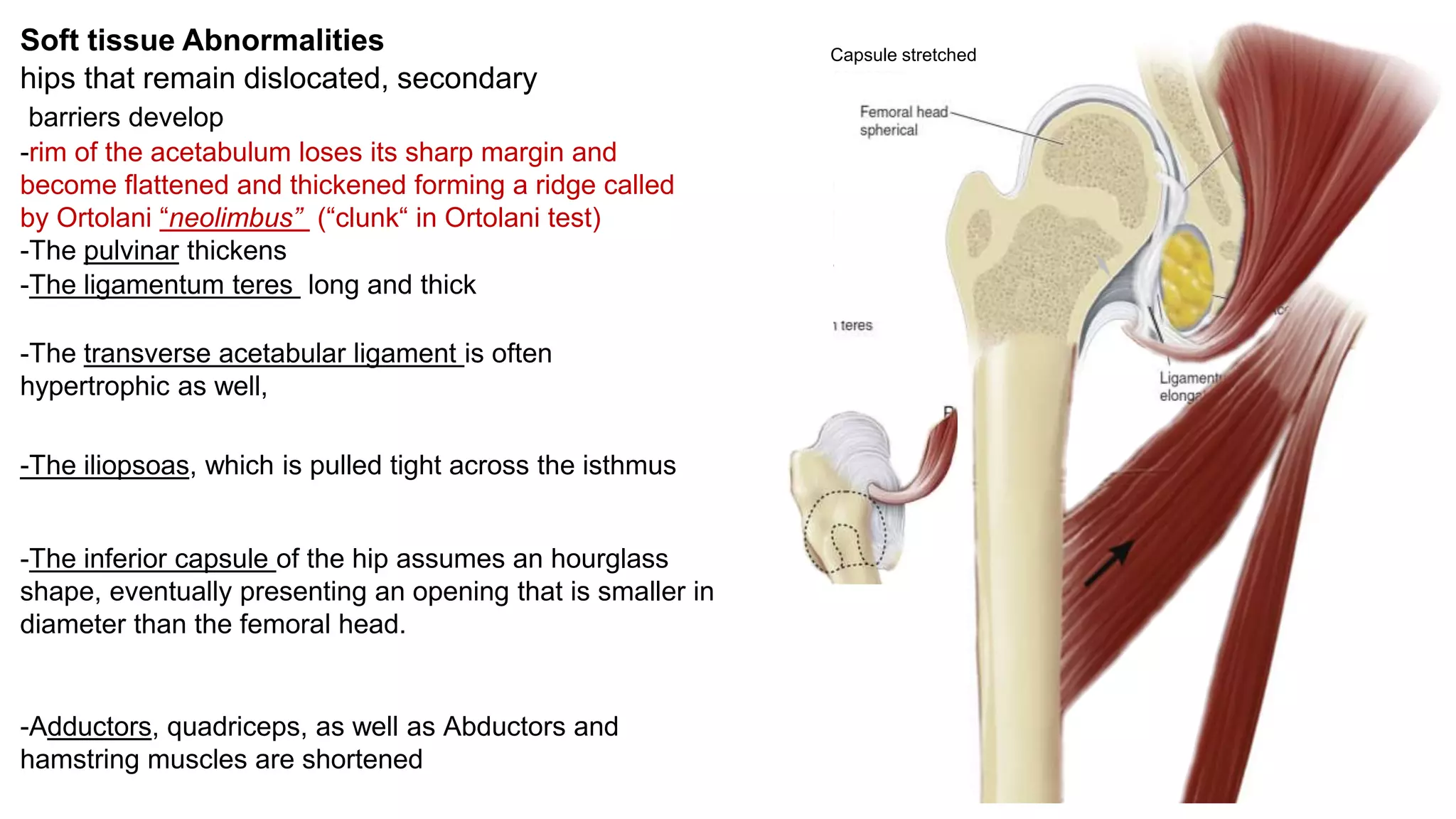 Soft tissue Abnormalities
hips that remain dislocated, secondary
barriers develop
-rim of the acetabulum loses its sharp margin and
become flattened and thickened forming a ridge called
by Ortolani “neolimbus” (“clunk“ in Ortolani test)
-The pulvinar thickens
-The ligamentum teres long and thick
-The transverse acetabular ligament is often
hypertrophic as well,
Capsule stretched
-Adductors, quadriceps, as well as Abductors and
hamstring muscles are shortened
-The inferior capsule of the hip assumes an hourglass
shape, eventually presenting an opening that is smaller in
diameter than the femoral head.
-The iliopsoas, which is pulled tight across the isthmus
 