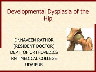 Developmental Dysplasia of the
Hip
Dr.NAVEEN RATHOR
(RESIDENT DOCTOR)
DEPT. OF ORTHOPEDICS
RNT MEDICAL COLLEGE
UDAIPUR
 