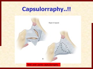 Devlopmental dysplasia of hip(DDH) by DR.NAVEEN RATHOR | PPTX