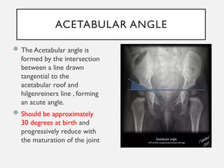 DEVELOPMENTAL DYSPLASIA OF HIP RADIOLOGY.pptx