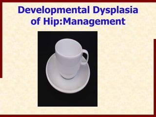 Developmental Dysplasia 
of Hip:Management 
 
