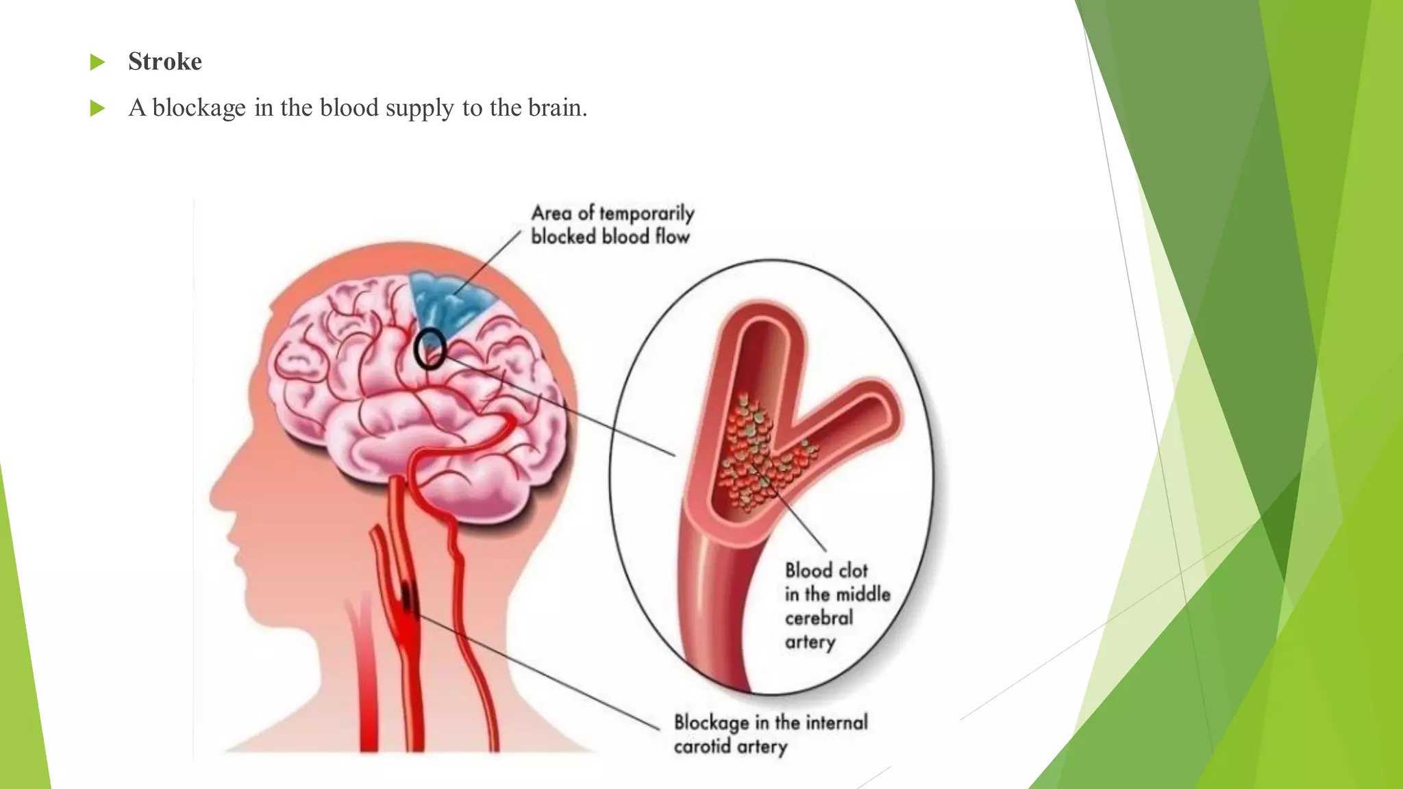  Stroke
 A blockage in the blood supply to the brain.
 