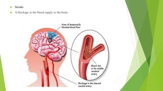  Stroke
 A blockage in the blood supply to the brain.
 
