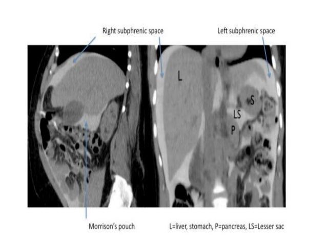 Peritoneum , Intraperitoneal Spaces