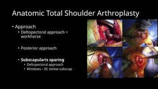 DDiStefano Shoulder arthritis and arthoplasty considerations | PPTX