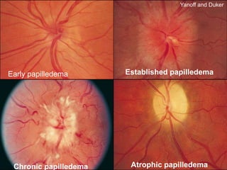 Early papilledema
Chronic papilledema Atrophic papilledema
Established papilledema
Yanoff and Duker
 