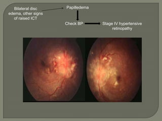 Papilledema
Check BP Stage IV hypertensive
retinopathy
Bilateral disc
edema, other signs
of raised ICT
 